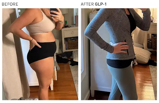 EMS + GLP-1 Treatment before and after results